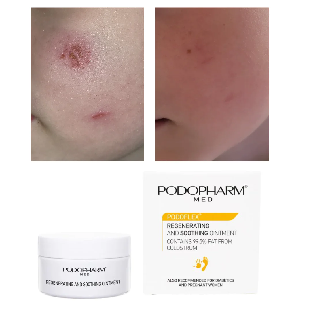 Podopharm REGENERATING AND SOOTHING OINTMENT, TERNESPIIMASALV 60MLkanda kahjustunud kohale vastavalt vajadusele. - Image 2